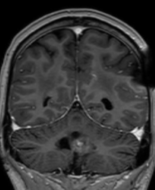 Hirntumor mit Kontrastmittel