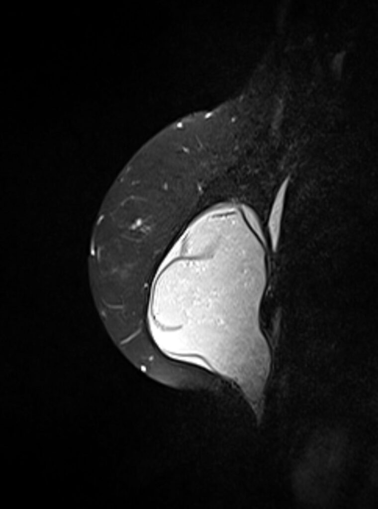 MRT Brust Silikon Implantate