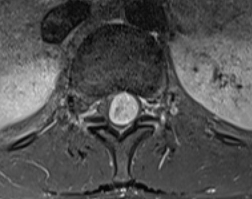 MRT Spinalkanaltumor