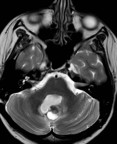 MRTKopf Hirntumor nativ