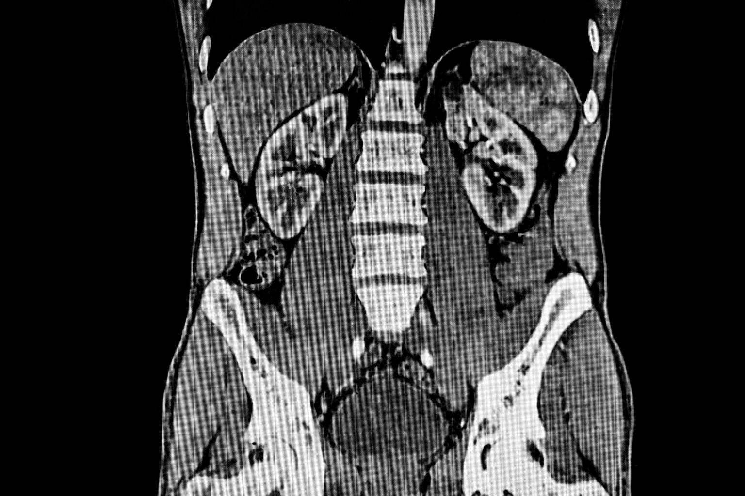 CT Abdomen