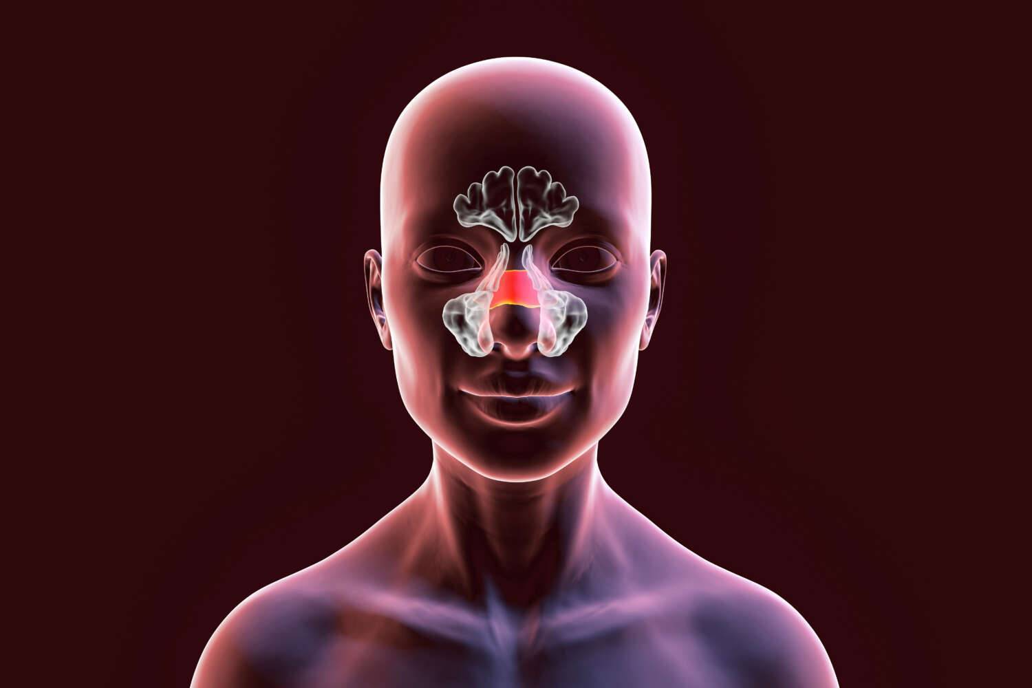 Sinusthrombose