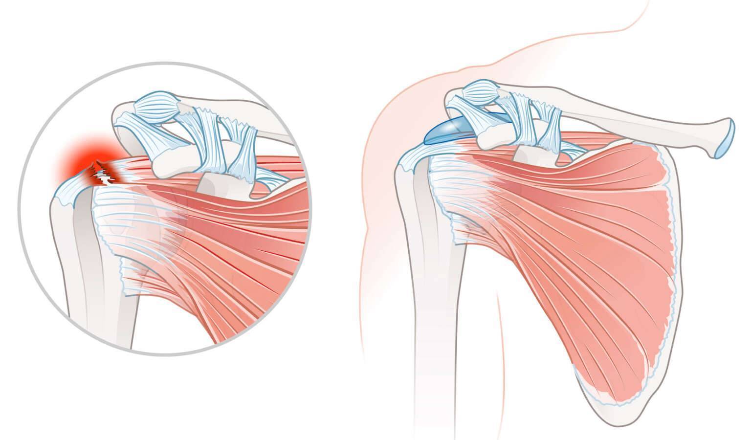 Supraspinatussehne: Verletzung Und Therapie | Medneo.com