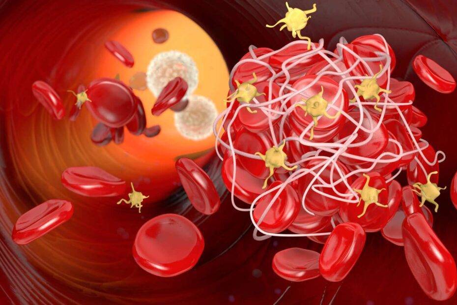 Thrombose