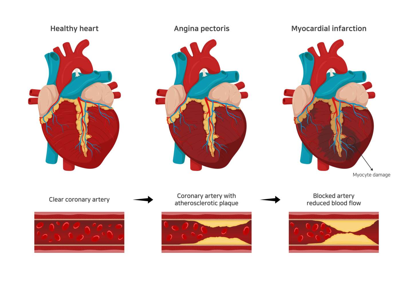 Angina Pectoris - Ursachen und Behandlung