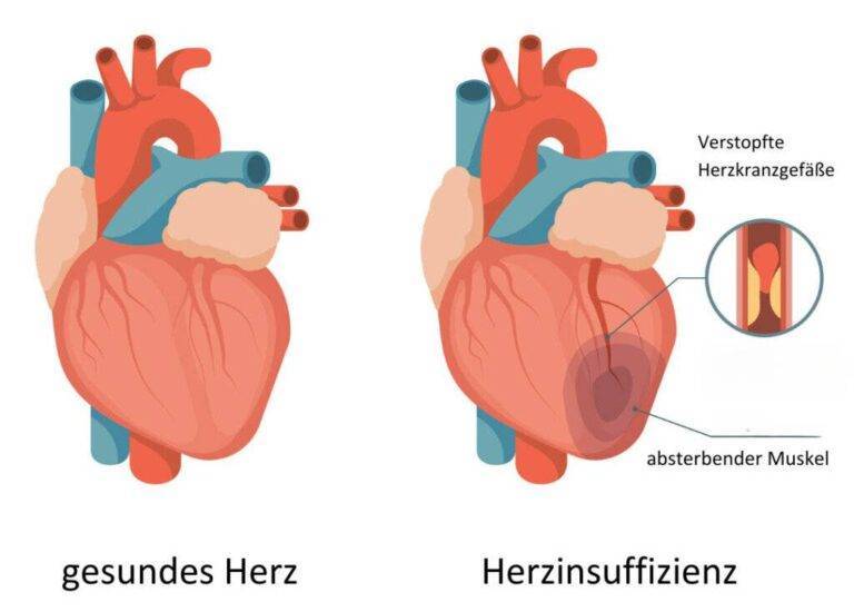 Herzinsuffizienz Symptome Und Behandlung